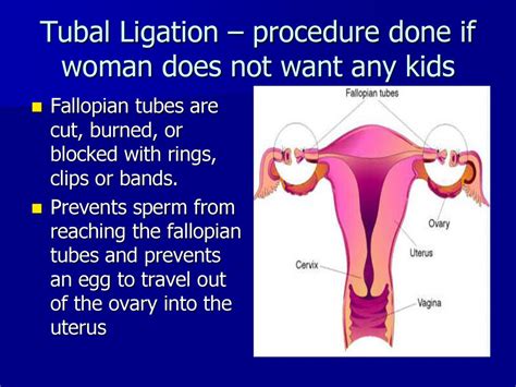 Surprising Benefits of Tubal Ligation: What Mayo Clinic Experts Say!